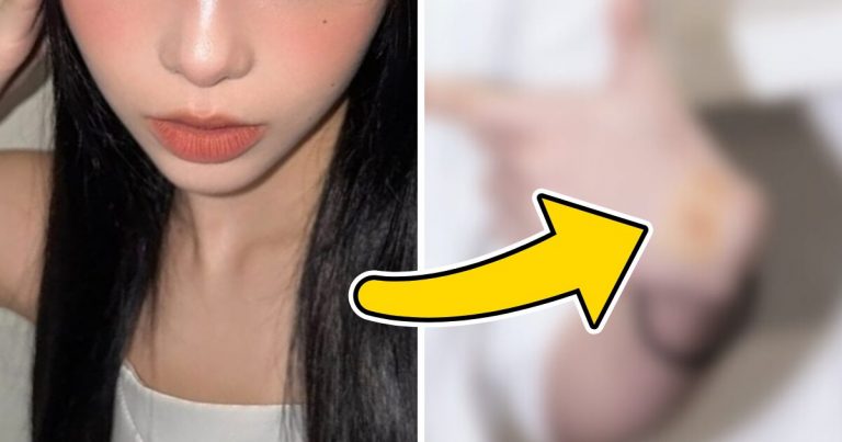 SM Entertainment Star’s Shocking Bruises Trigger Concern